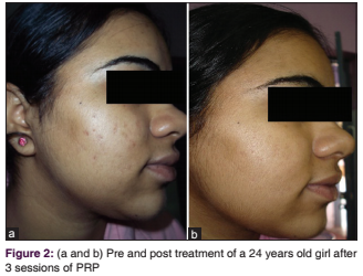 Platelet Rich Plasma in Dermatology and Aesthetic Medicine