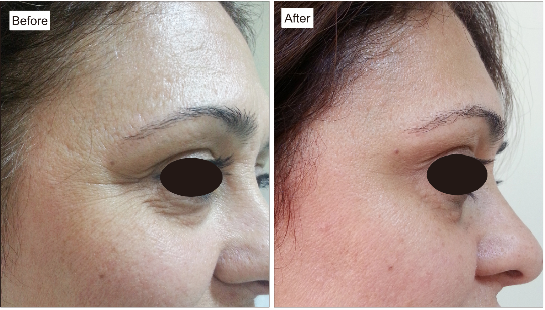 PRP and Collagen Formation