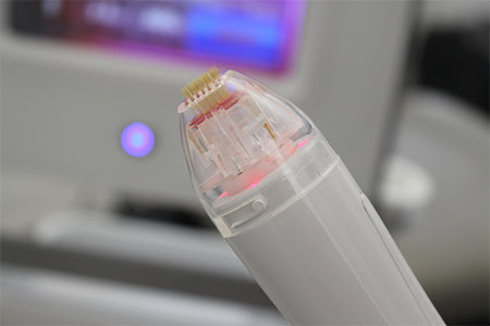 Vivace RF Microneedling