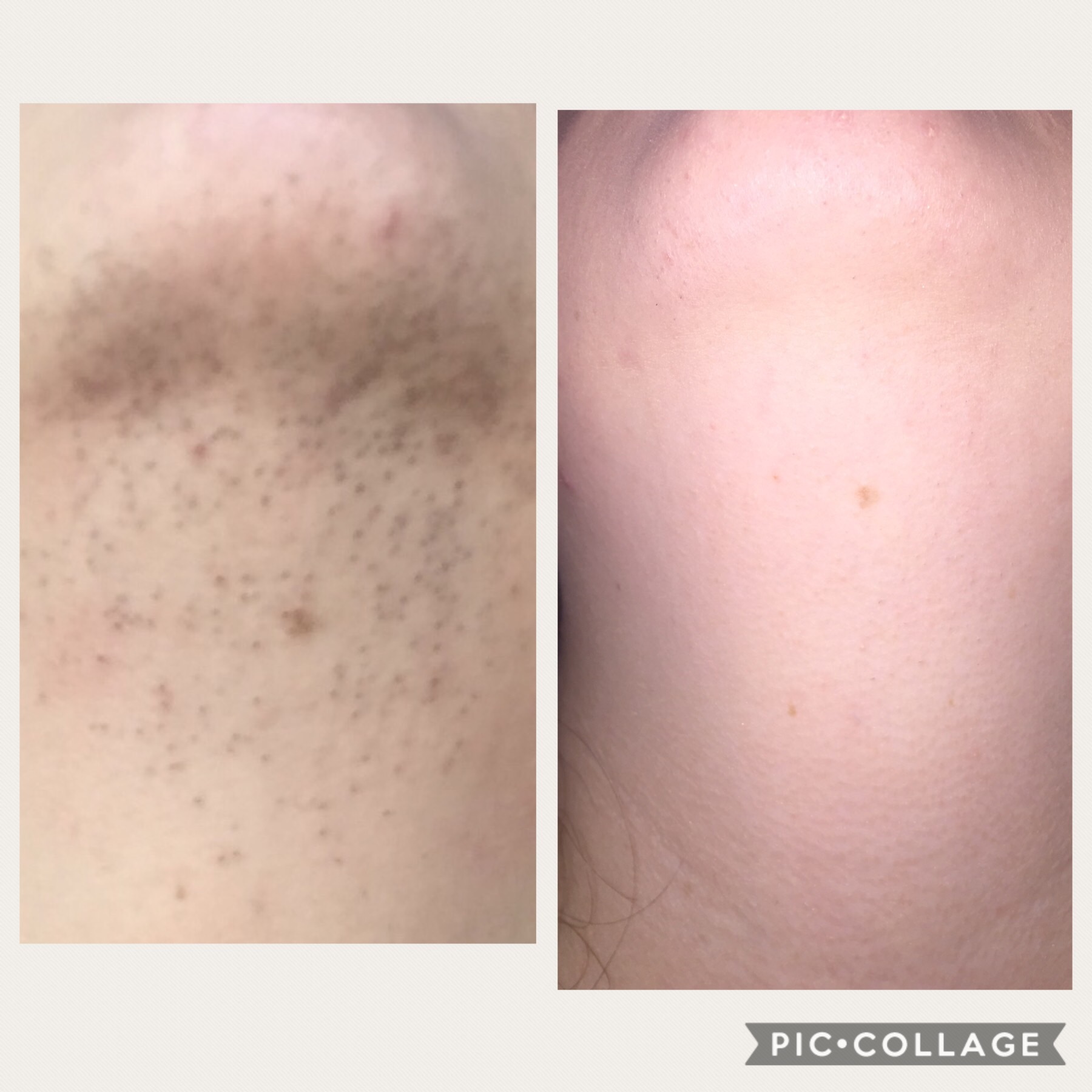 Motus ax laser hair removal