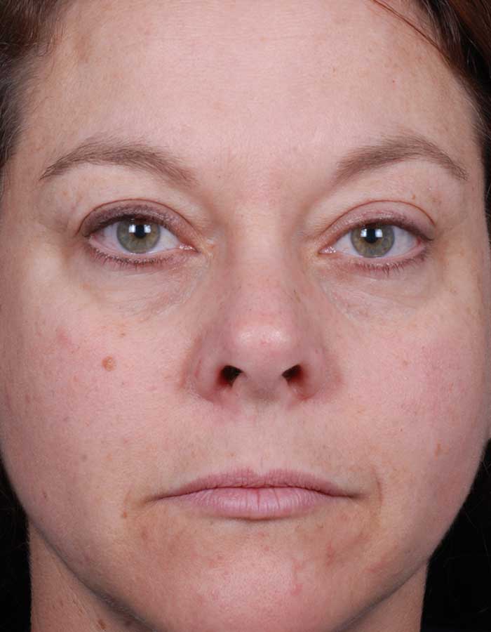 BeforeAfter_BluePeels_1_After