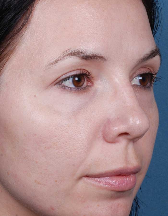BeforeAfter_BluePeels_3_After