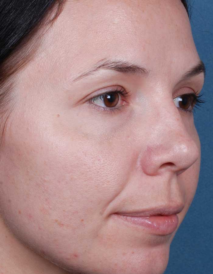 BeforeAfter_BluePeels_3_Before